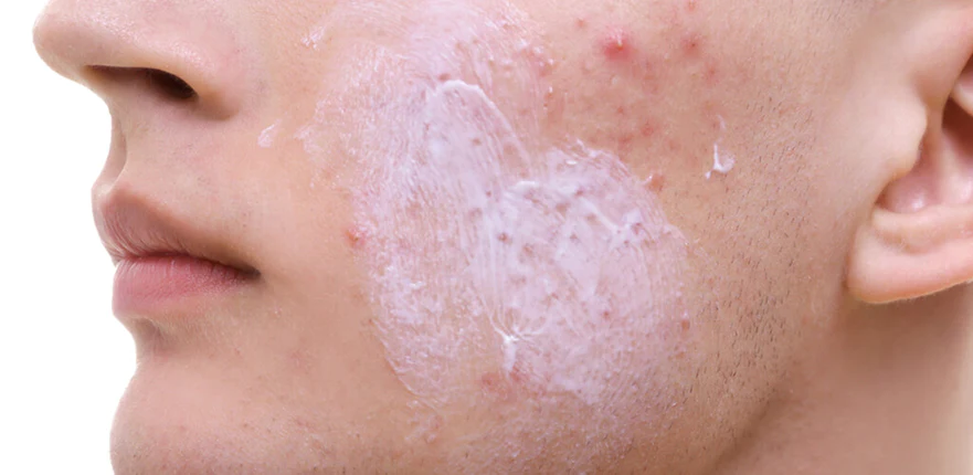 Alert: Your Acne Cream Might Be Risky! Shocking Findings on Benzene in Top Skincare Brands
